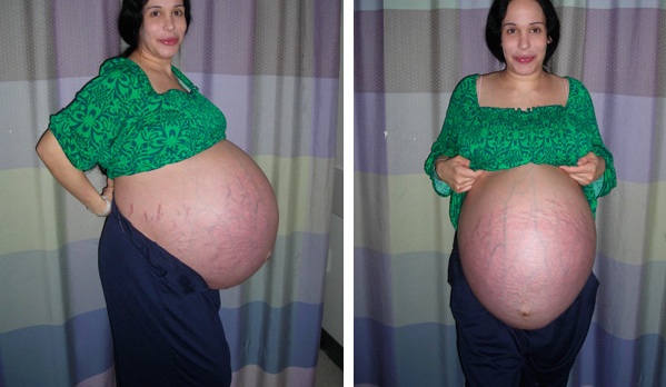 Photos Of Octuplet Mother Nadya Suleman Pregnant 