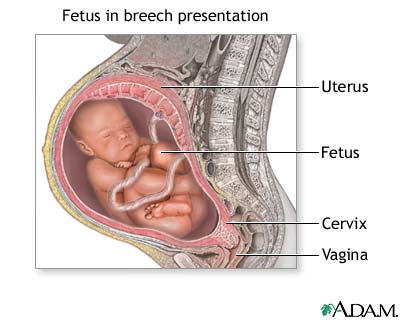 images of babies. for breech abies!