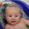 cradle cap