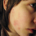 food sensitivity eczema